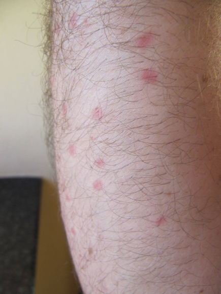 Quelques piqûres de midges...